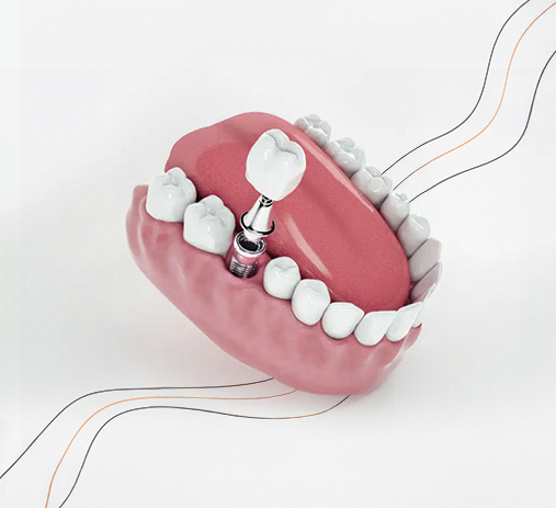 Prótese Sobre Dente